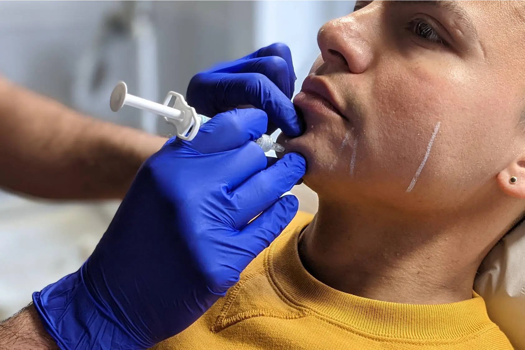 Advanced dermal filler training - chin and jawline